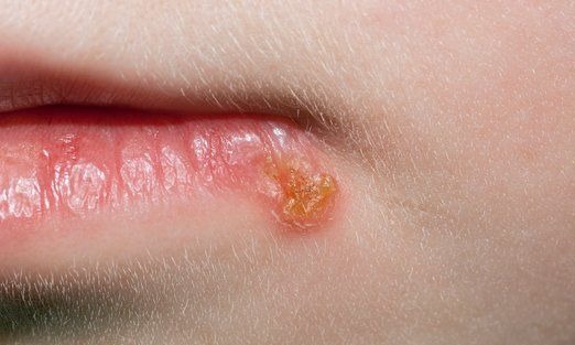 چه چیز باعث تبخال می‌شود؟ + درمان فوری 