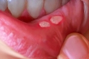 علت به وجود آمدن زخم دهان و زبان چیست؟
