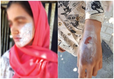  نامادری با اتو بدن دختربچه را داغ می‌کرد+عکس
