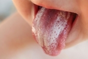 برفک دهان چیست؟+ روش‌های خانگی برای درمان