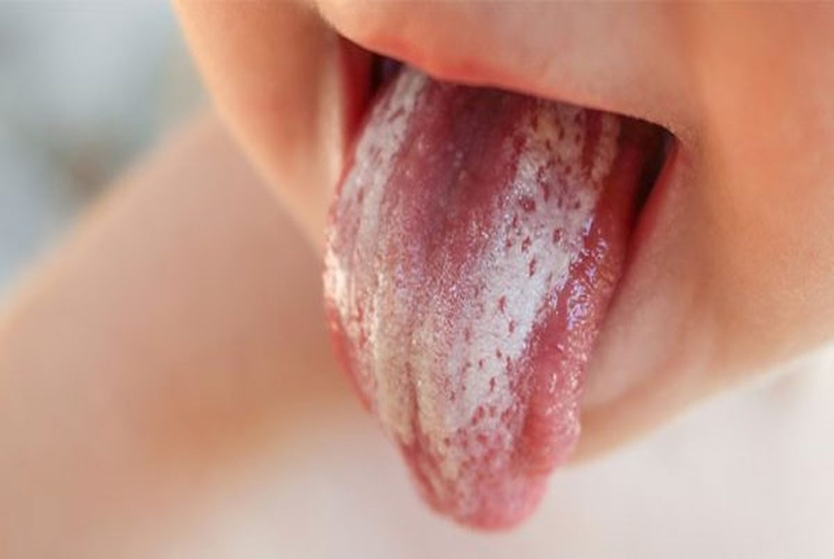 برفک دهان چیست؟+ روش‌های خانگی برای درمان
