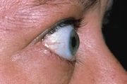 تیروئید چشمی چیست و چه علائمی دارد؟