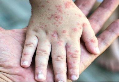 حذف سرخک و سرخجه در ایران
