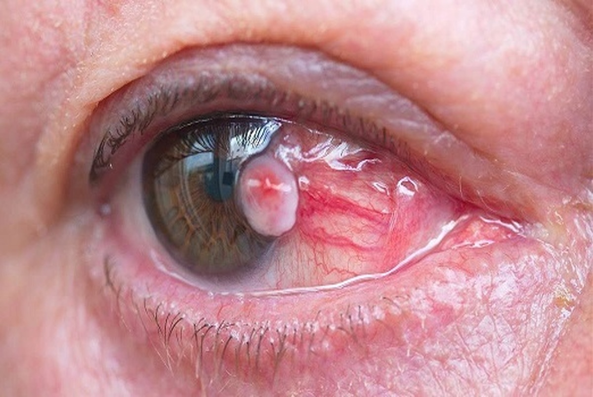 علائم ابتلا به سرطان چشم را بشناسید