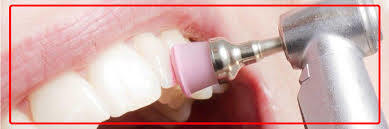 جرم گیری نامناسب دندان باعث بیماری لثه می شود