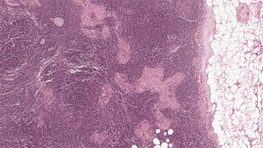 مهار سلول های سرطان سینه با گیاه فرفیون انجام شد