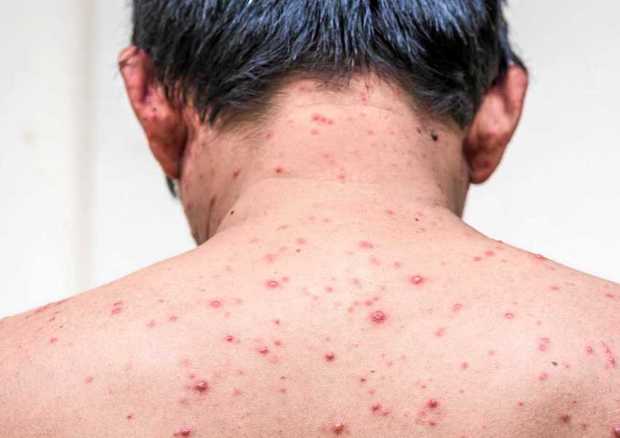 ابتلای کودکان به آبله مرغان خطرناک نیست
