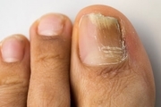 6 درمان خانگی برای قارچ ناخن انگشت