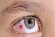  سرطان چشم به سن مبتلایان ارتباط دارد؟+ علائم هشدار دهنده
