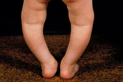 چرا کودکان دچار پای پرانتزی می شوند؟

