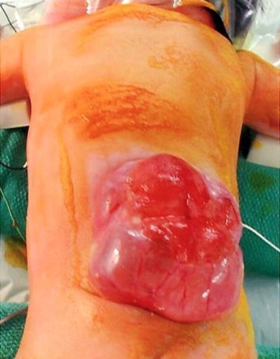 عمل موفقیت آمیز روی نوزاد سه ماهه در سمنان