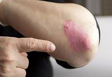 دلیل مهم اگزما در پوست