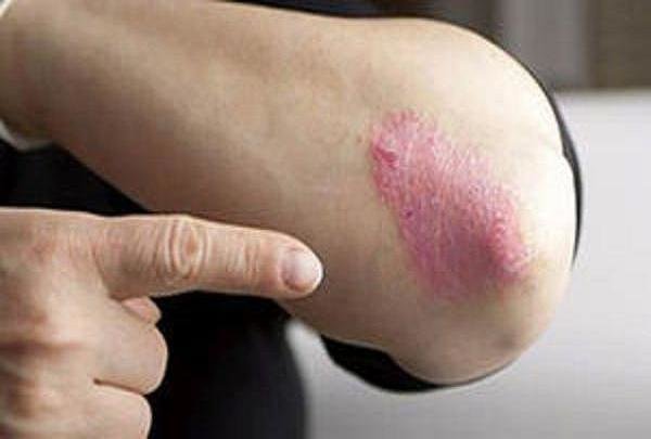 دلیل مهم اگزما در پوست