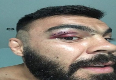 تصویری از مصدومیت امیر علی اکبری در مسابقات MMA
