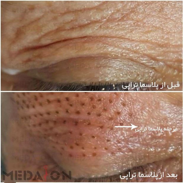 بلفاروپلاستی بدون جراحی (درمان افتادگی پلک)
