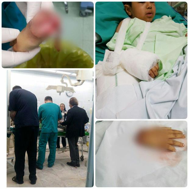 دست قطع شده کودک زلزله زده پیوند زده شد