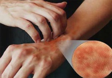 خارش شدید پوست هنگام شب از علائم بیماری گال است
