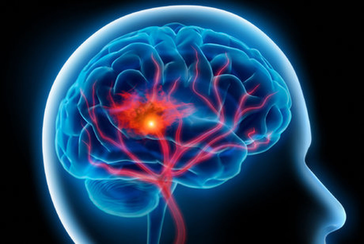 3 عامل مهم در پیشگیری از سکته مغزی