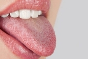 چیزهایی که باید از خشکی دهان بدانید