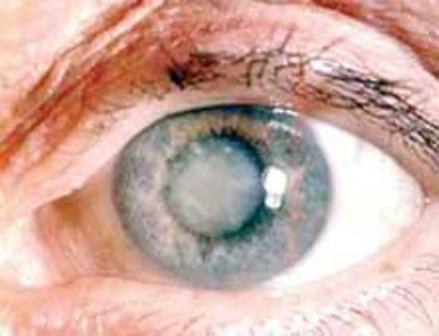 متخصص چشم: تخریب ماکولا شایع ترین علت کم بینایی سالمندان است