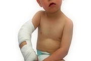 تشخیص شکستگی آرنج کودکان بدون استفاده از اشعه
