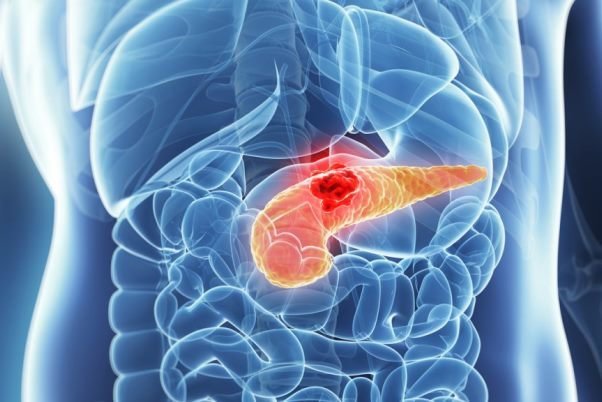 نقش میکروب‌های دهان در بروز سرطان پانکراس

