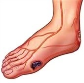 علت اصلی قطع پای بیماران دیابتی