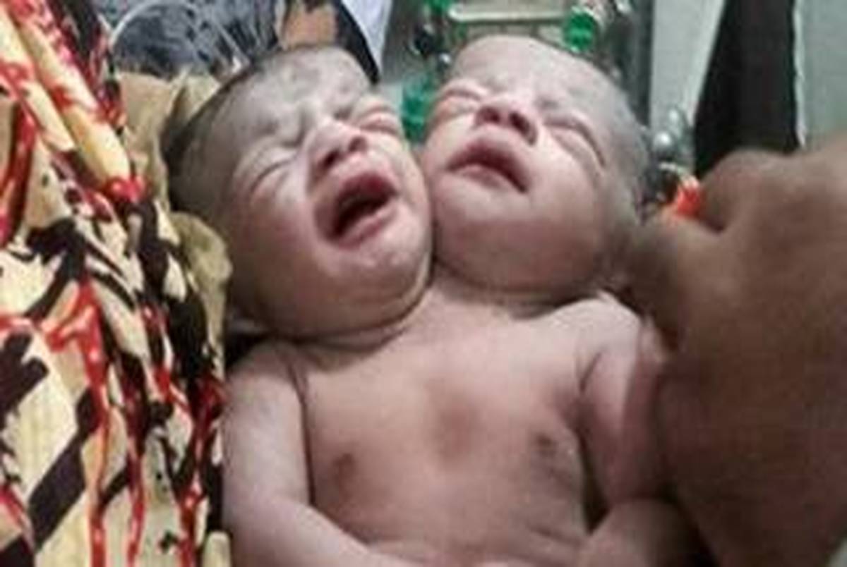 تولد نوزاد دو سر در بنگلادش