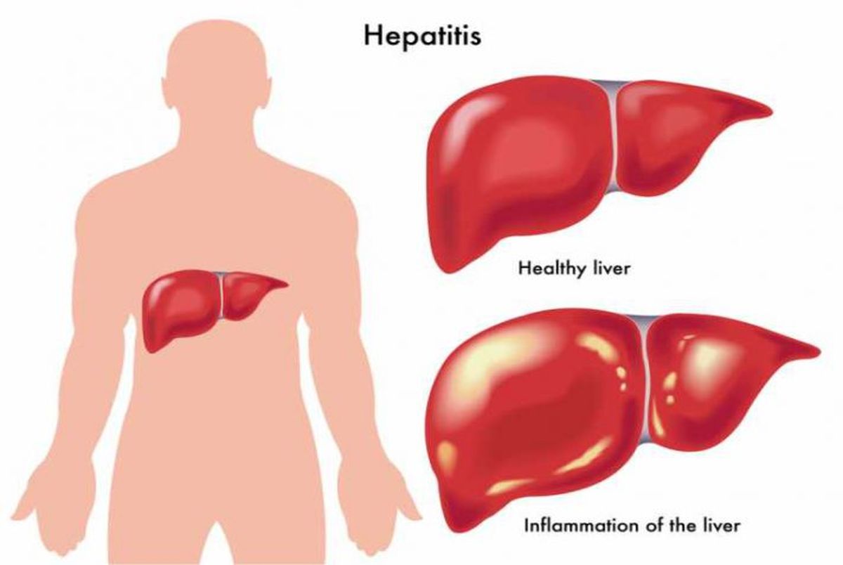 هپاتیت C طی ۲۰ سال آینده ریشه‌کن می‌شود