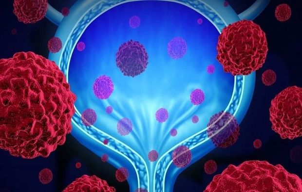 تشخیص تومورهای کوچک با این آزمایش