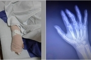 مامور حراست بیمارستان انگشتان دست خانم خبرنگار را شکست + عکس