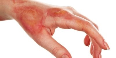 هنگام مواجهه با مصدومان سوختگی چه اقدامی انجام دهیم؟
