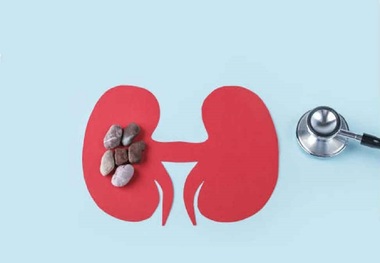 ۶ باور غلط درباره سنگ‌های ادراری