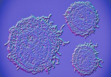 تست بزاق برای ردیابی سریع سرطان پروستات 
