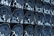 تشخیص میزان آسیب مغزی با هوش مصنوعی