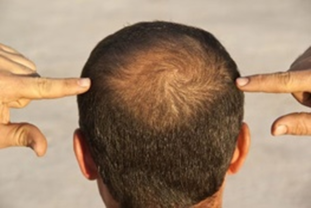 رشد مو با نصب میکرو ال‌ای‌دی در سر 