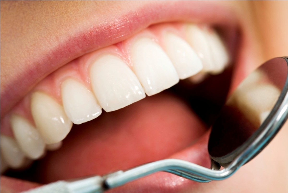 هر آنچه که باید درباره سفید کردن دندان‌ها بدانید