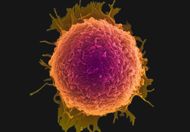  درمان مرگبارترین نوع سرطان!
