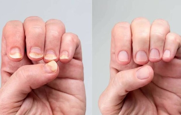 تغییر رنگ ناخن‌ها نشانه چیست؟