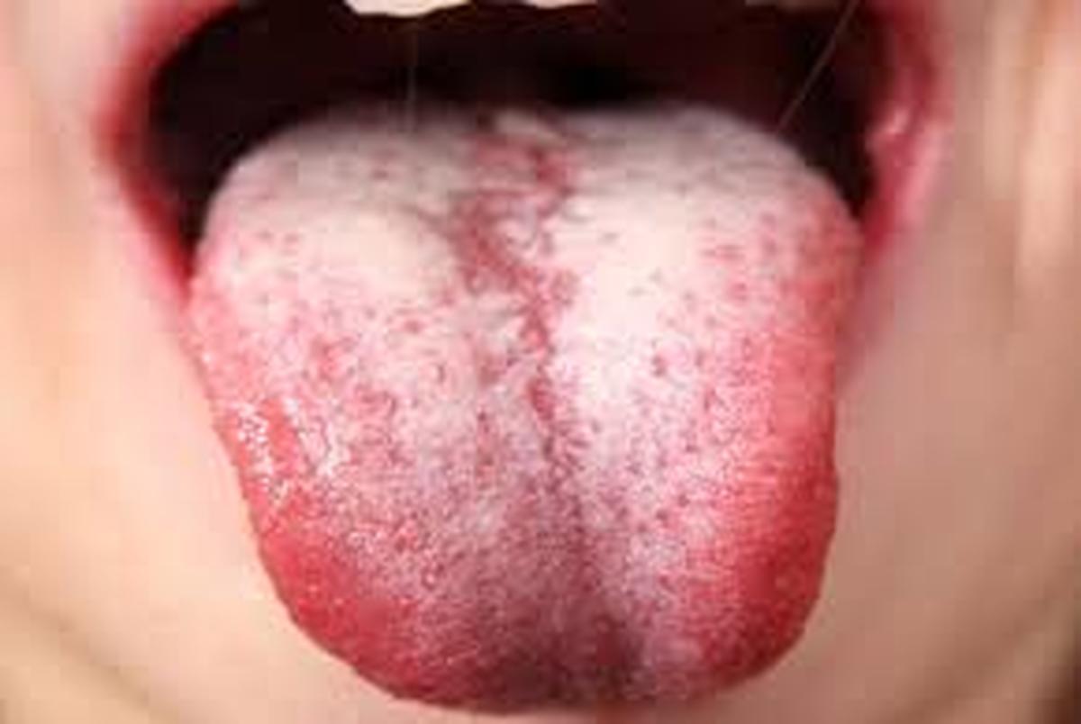 چزا زبان سفید می شود؟ چه طور درمان می شود؟