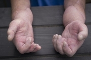 نخستین پیوند دست فرد مبتلا به اسکلرودرمی در بریتانیا
