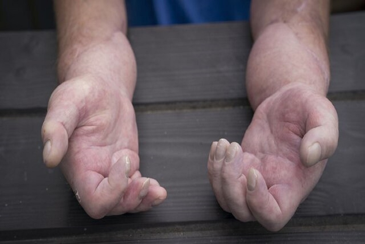 نخستین پیوند دست فرد مبتلا به اسکلرودرمی در بریتانیا
