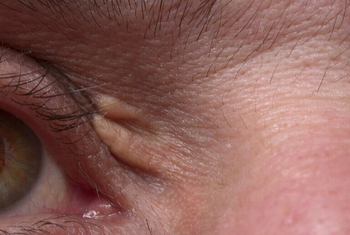 علائم اطراف چشم که از بالا بودن کلسترول خون خبر می دهد
