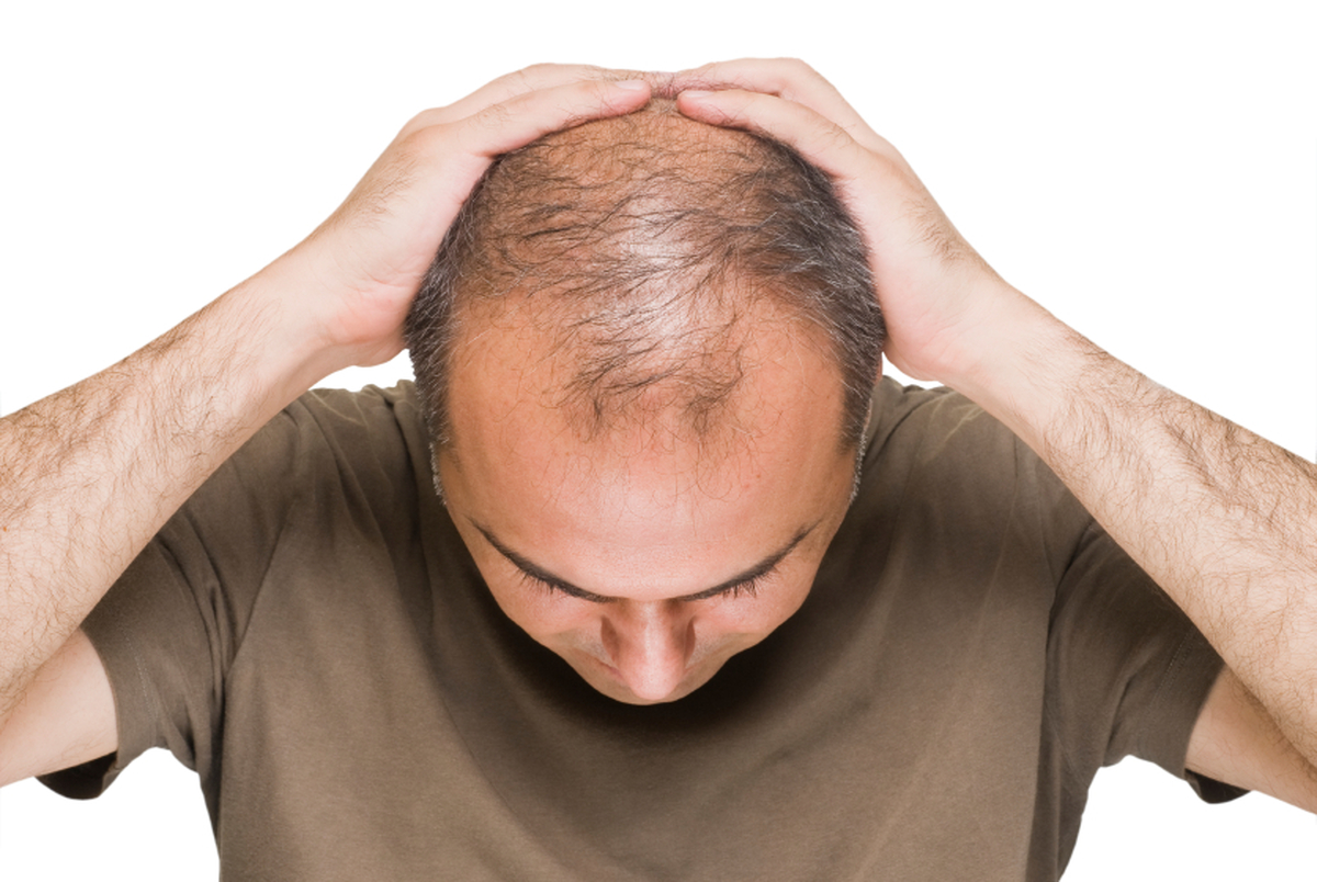 علل مهم و تاثیرگذار در ریزش مو