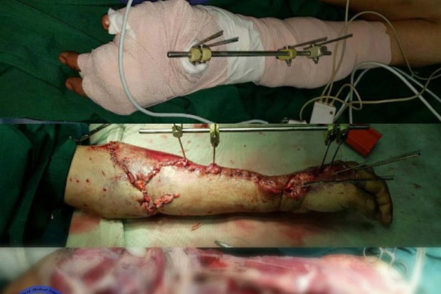 جراحان با سرعت عمل مانع از قطع دست پیرمرد قزوینی شدند