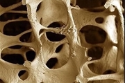 راهی جدید برای درمان پوکی استخوان