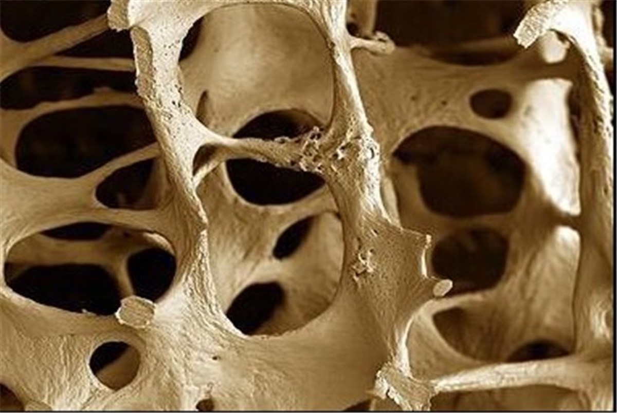 تشخیص بیماری پوکی استخوان از روی تراشه‌های ناخن 