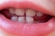 بهترین زمان معاینه ارتودنسی دندان کودکان