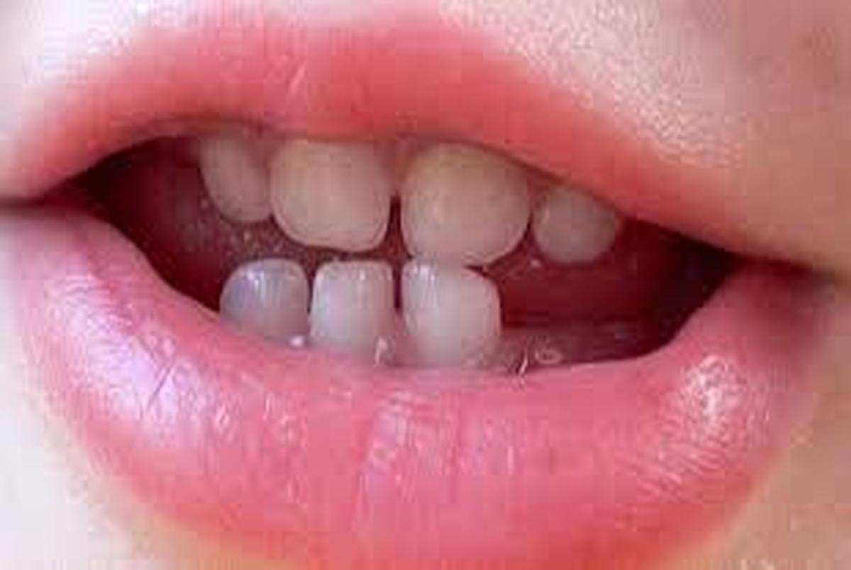 آنچه باید درباره دندان های شیری بدانید