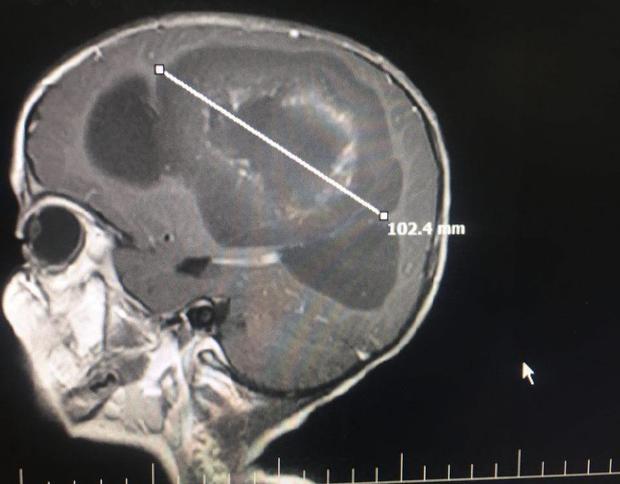 خارج کردن تومور مغزی 10 سانتیمتری از سر کودک قزوینی